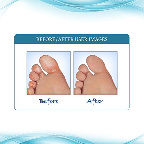 FUNGINIX AF Athletes Foot Cream - Topical Anti-Fungal Treatment, Eliminates Athlete's Foot Infections, Safe & Effective (1 Ounce)