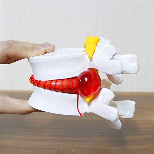 Miniatura 2 de Anatómica Hernia Lumbar Vértebras Disco Prolapso Modelo Anatomía Humana Modelo Blanco