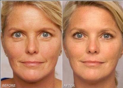 Miniatura 4 de Gel de retinol 0.1 Vitamina A repara líneas finas y arrugas, tratamiento de cicatrices, edad y manchas solares, gel de fórmula antienvejecimiento