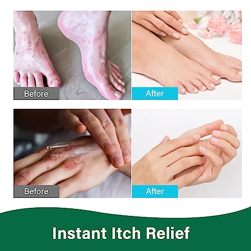 Image of HIPFATE Athletes Foot Treatment Spray, 30ML