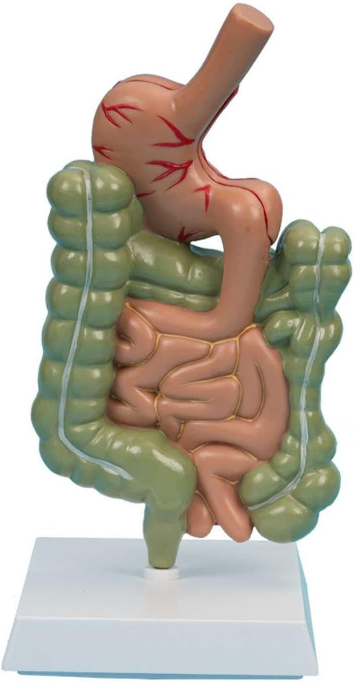 SENJINGHUA Pathological Digestive System Model, Human Colon Lesion Model, Gastrointestinal Large Intestine Lesion Model for Intestinal Disease Medical Research.