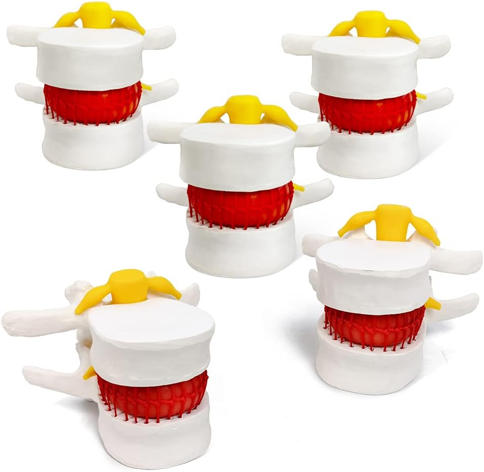 EVOTECH SCIENTIFIC Human Herniated Disc Anatomy Model, 5 Pack