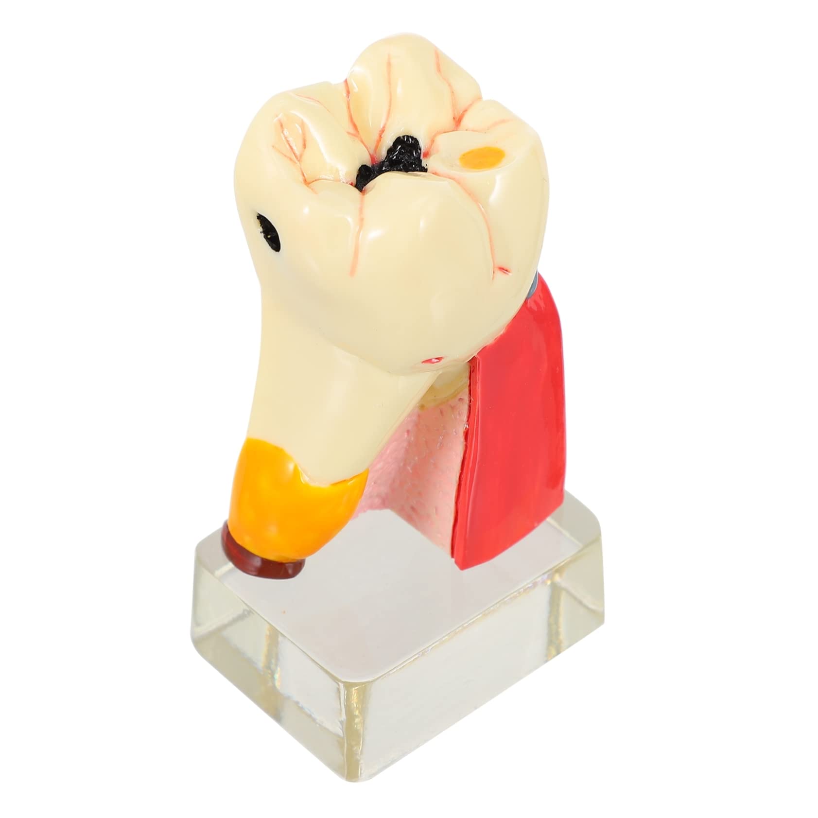 Modello di Carie Dentale in Resina Beige Leggero per Dimostrazione | Strumento Didattico Odontoiatrico, Modello Anatomico Denti per Studio, Materiale Resina