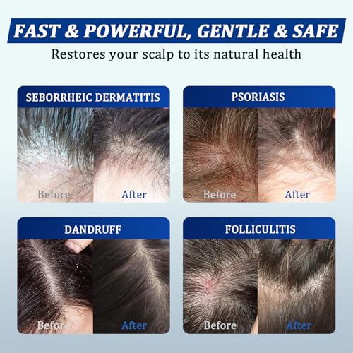 Image of Anti-dandruff Shampoo & Conditioner Set: For Folliculitis, Scalp Psoriasis & Seborrheic Dermatitis, Relieves Redness, Itching, Flaking & Dryness, Strengthens, Repairs & Boosts Shine - 20.28 fl.oz | Antifungal Set Seborrheic Dermatitis, Relieves Redness, Itch, Flaking & Dryness, Strengthens & Repairs Shine - 20.28 fl oz