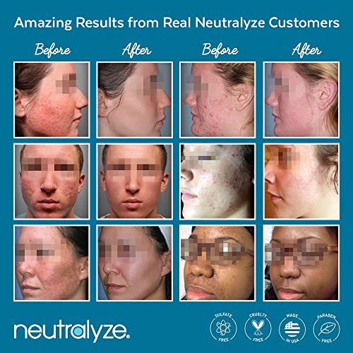 Neutralyze Exfoliating Acne Wipes - Maximum Strength, Dual Textured Acne Pads For Face & Back - Medical Grade 2% Mandelic Acid & Salicylic Acid Pads - Acne Cleansing Pads (100 Acne Face Wipes) #TOP5