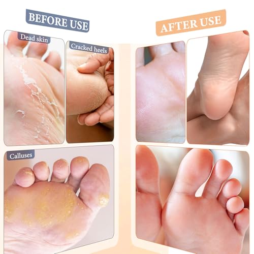 Z:SEA Foot Peeling Mask 5 Pack, Foot Mask for Dry, Cracked Feet, Exfoliator Peel Off Calluses Dead Skin, Repairs & Softens Rough Skin, Foot Spa Moisturizing Socks with Urea, Shea Butter, Jojoba oil - Image 4