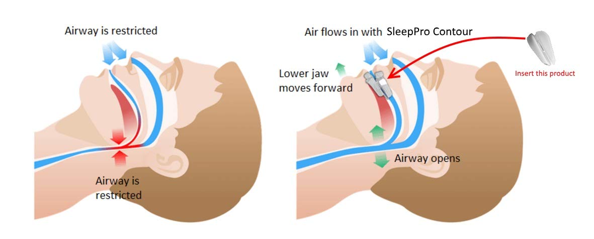 SleepPro Contour, zweiteilige Premium Unterkieferprotrusionsschiene, gegen Schnarchen,