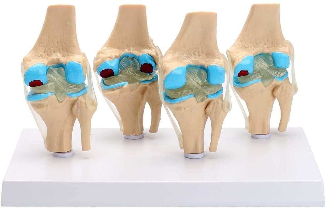 Modele medyczne, ludzki szkielet stawu kolanowego Model anatomiczny nauka medyczna materiały dydaktyczne osteoporoza modele stanu chorobowego 1 zestaw odłączany