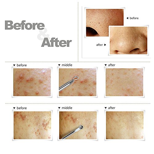 Valoxin (TM) 7PCS/aghi cura della pelle acciaio