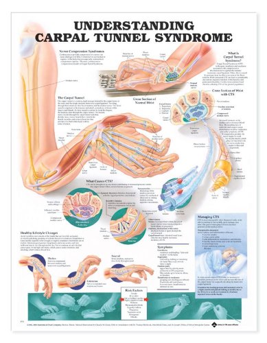 Image of Understanding Carpal Tunnel Syndrome Anatomical Chart