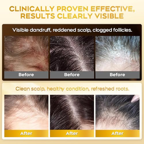 Image of Enhanced Antifungal Shampoo for Seborrheic Dermatitis & Folliculitis-Fresh