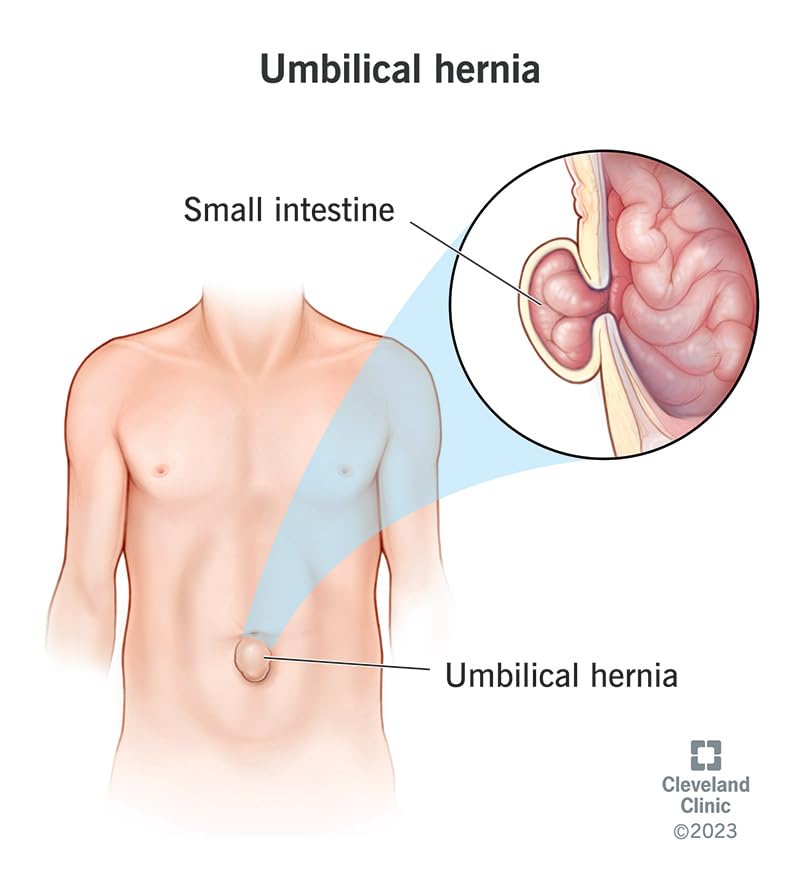 Cinta abdominal para hernia umbilical talla mediana miniatura 7