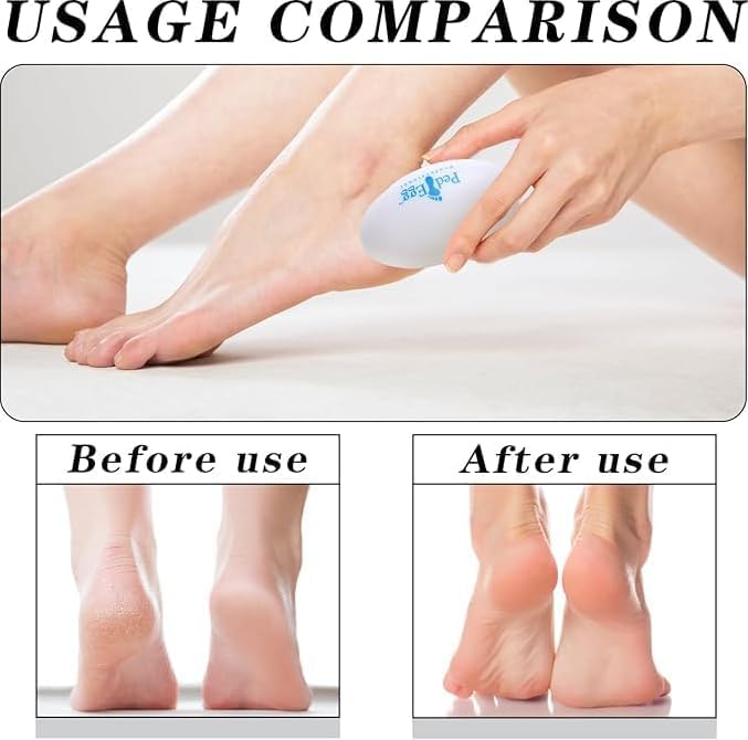 Xeerabdi Foot Scrubber Egg Shape | Pedicure Callus Remover Tool | Dry, Cracked Heels Smooths Feet with Gentle Exfoliation | Compact, Ergonomic & Easy to Clean 3