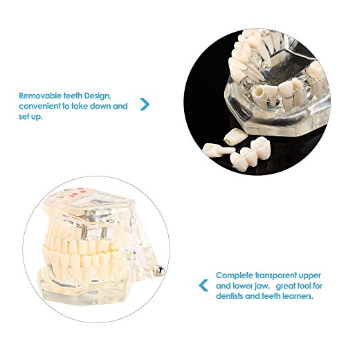 Transparent Dental Implant Disease Teeth Model Dentist Standard Pathological Removable Tooth Teaching Model Tools