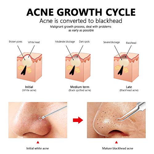 Mee-eter Verwijderaar Set - 8 Stuks, Professionele Roestvrijstalen Risicovrije Mee-eter Extractor-gereedschapsset… - Afbeelding 7