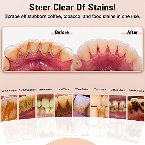 Ocallcoo OC Plaque Remover For Teeth thumb #3