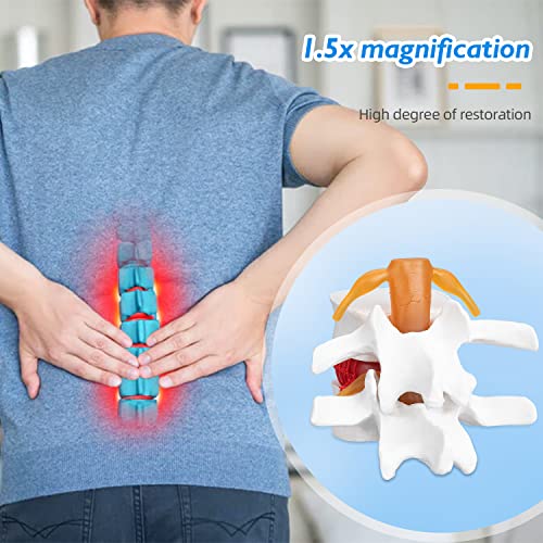 Image of Disc Herniation Model - 1.5X Lumbar Herniated Disc Model Vertebral Spine Anatomical Medical Model