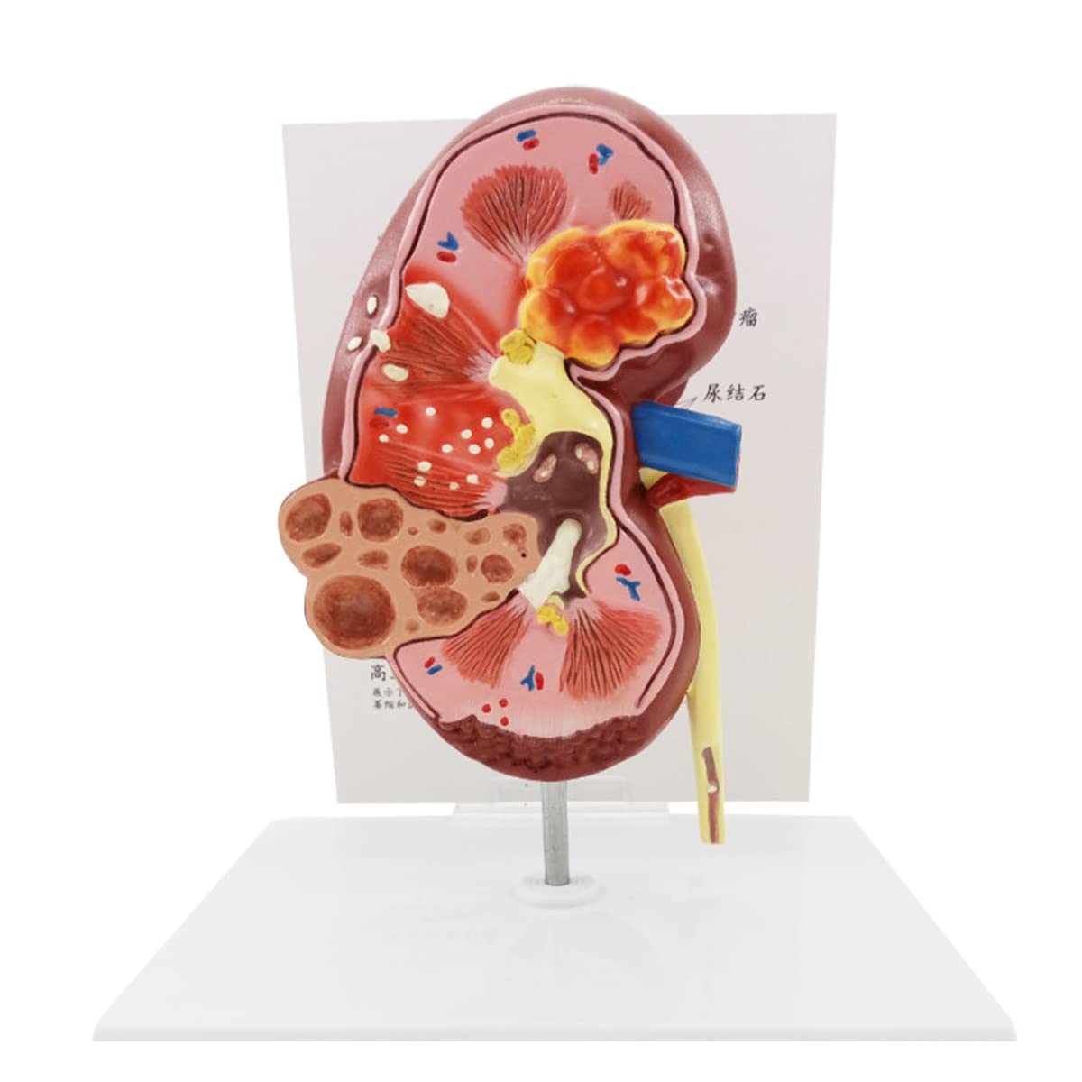 Pathologisches Modell, menschliches Nierenläsionsmodell, Anatomie, pathologisches Steinorgan, Nierensteine, Urologie, Nierenmodell für medizinische Lehr-/Bildungsbedarf