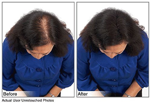 image for JUVEKER Hair Building Fibers Instantly Conceal Thinning Hair and Bald 
