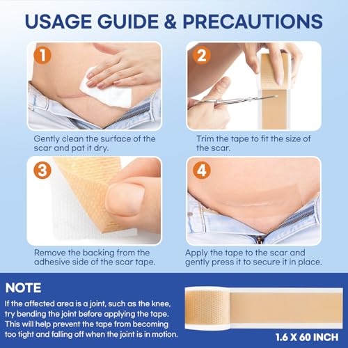 Aroamas Scar Silicone Scar Sheets – Silicone Scar Tape – 1.6"x60" for Softening and Flattening Scars, C-Section, Keloid, Surgery – Reusable & Washable – Painless Removal – 3-4 Month Supply