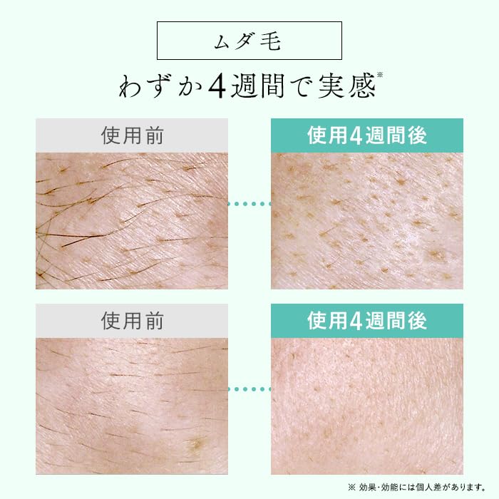 ステラボーテ IPL & LED 光美容器