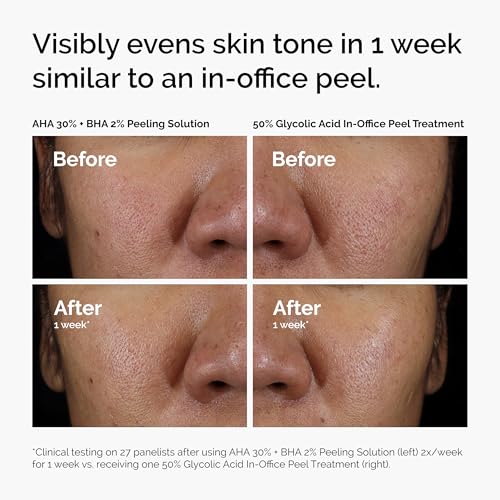 Image of The Ordinary AHA 30% + BHA 2% Peeling Solution, Advanced Exfoliating Peel for Brighter Skin