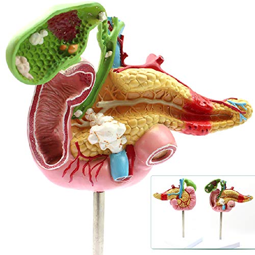 Modèle anatomique du pancréas pour expliquer les pathologies aux patients - 2