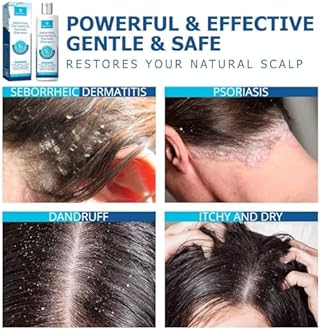 Roycederm Psoriasis Shampoo, Seborrheic Dermatitis Shampoo, Folliculitis Shampoo, Dandruff Shampoo, Scalp Psoriasis & Seborrheic Dermatitis Treatment, Dry Itchy Scalp Treatment