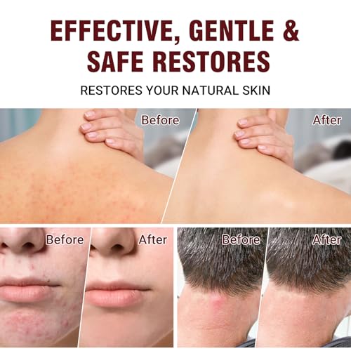 Image of Folliculitis Treatment Cream, 3.52oz | Fast-Acting Relief for Scalp, Face & Body, Soothes Itching, Redness & Inflammation, Natural Colloidal Oatmeal Formula