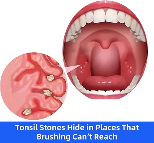 Miniatura 2 de Kit de eliminación de piedras amígdalas, manual y portátil, eliminación de piedras amígdalas en la garganta (reemplazo gratuito para daños en el