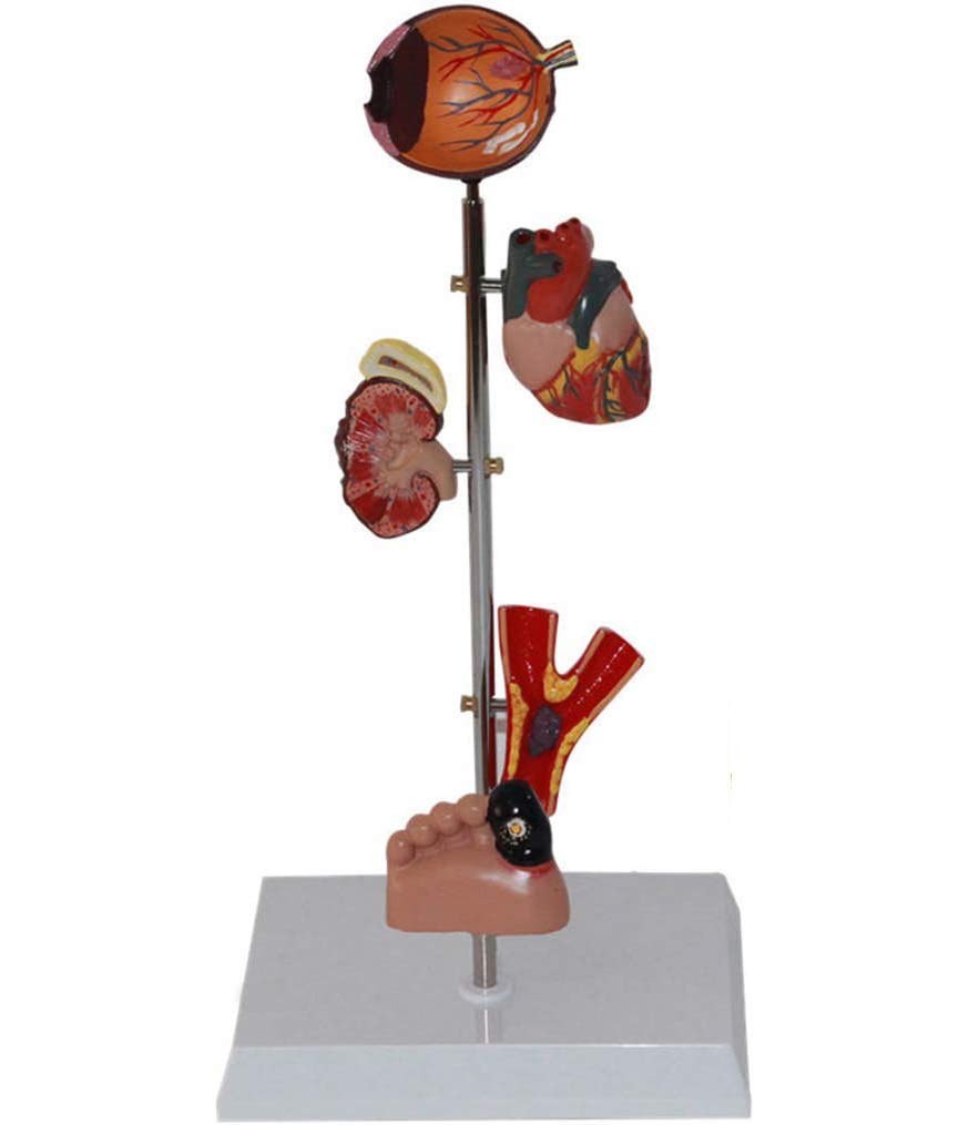 KJMWXOP Diabetes Organ Model - Diabetes Medical Anatomical Model - Removable Human Anatomical Model Scientific Human Anatomy Models - For Training Aid