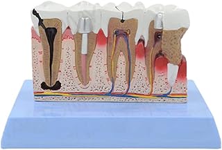 Anatomy Model Teaching Model Dental Pathology Teeth Model Decay Teeth Comparative Study Model Human Body Model Tooth Model Study Education