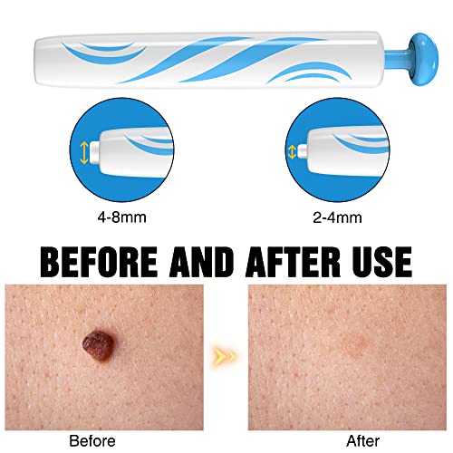 Foreverup Stielwarzen Entfernen Schnell Kit, Skin Tag Entferner, 2 In 1 Skin Tag Remover, Auto Skin Tag Remover Kit für… - Image 3