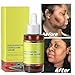 Dark Spot Remover for Face Body: Dark Spot Corrector Face Serum for Age Spot Sun Spot Freckles Brown Spot for Women & Men - 30m