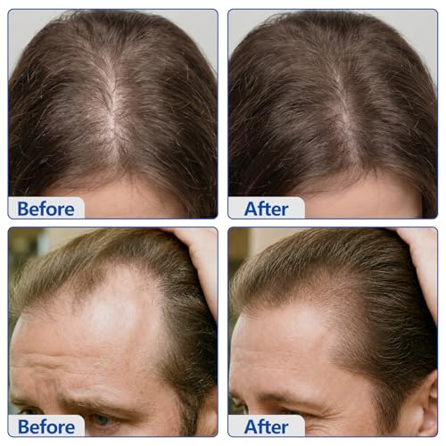 5% Minoxidil for Men & Women Hair Growth, Topical Cream Hair Regrowth Treatment for Thinning & Hair Loss, Biotin & Caffeine for Fuller Thicker Hair, Non-Greasy, 3.5oz — view 6