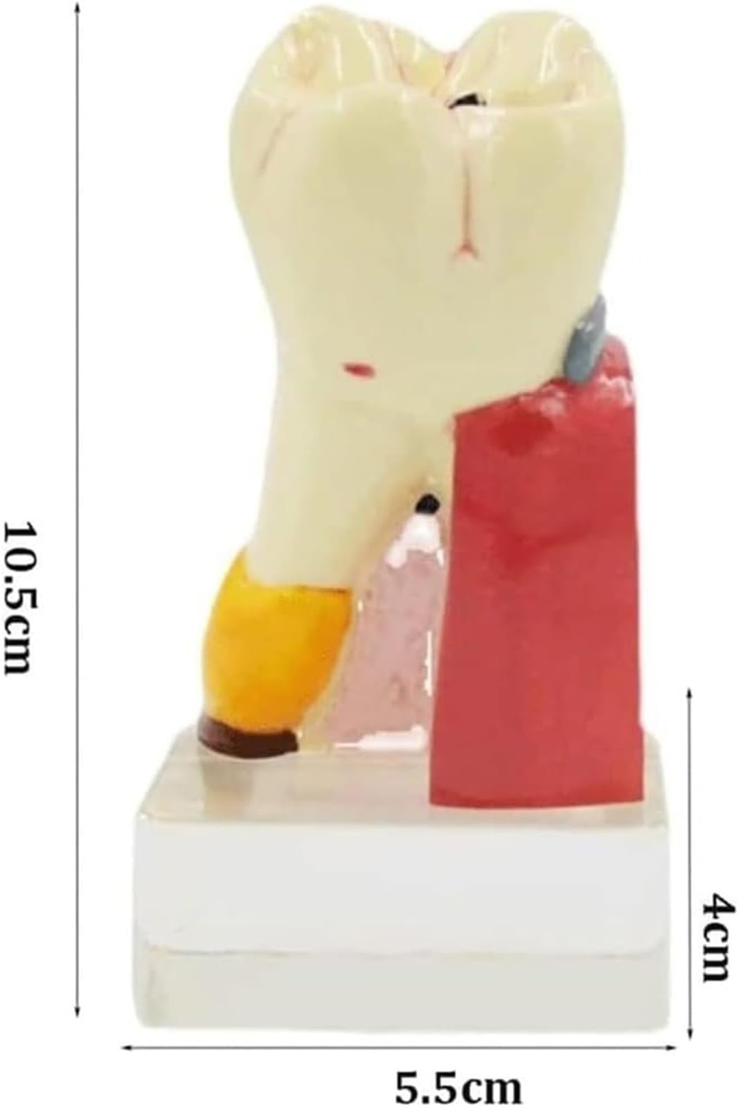 4X powiększony model anatomiczny próchnicy zębów z antypoślizgową podstawą - Dentystyczne narzędzie edukacyjne do demonstracji postępu próchnicy i struktury zęba