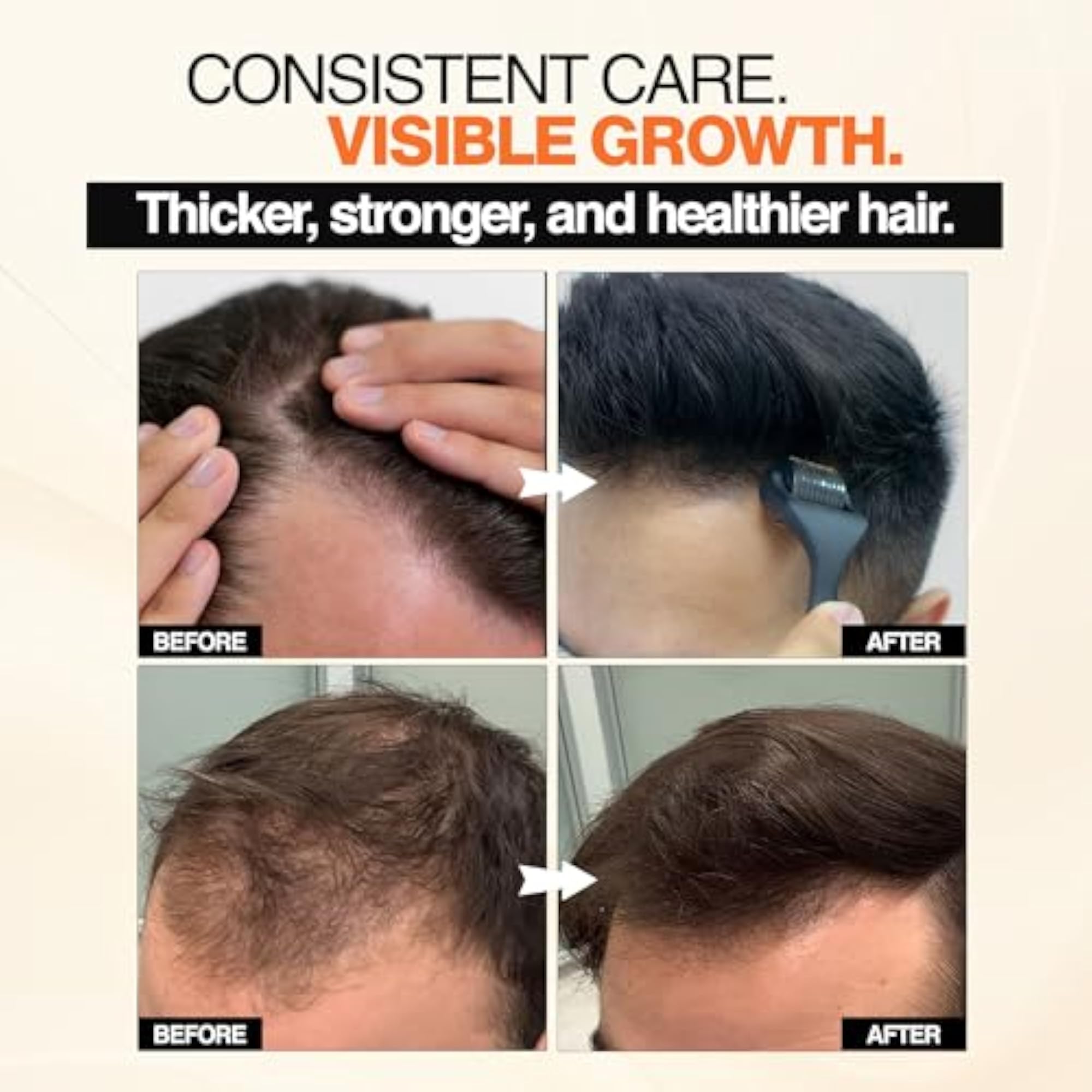Derma Roller & Advanced Hair Growth Serum with Rosemary Extract