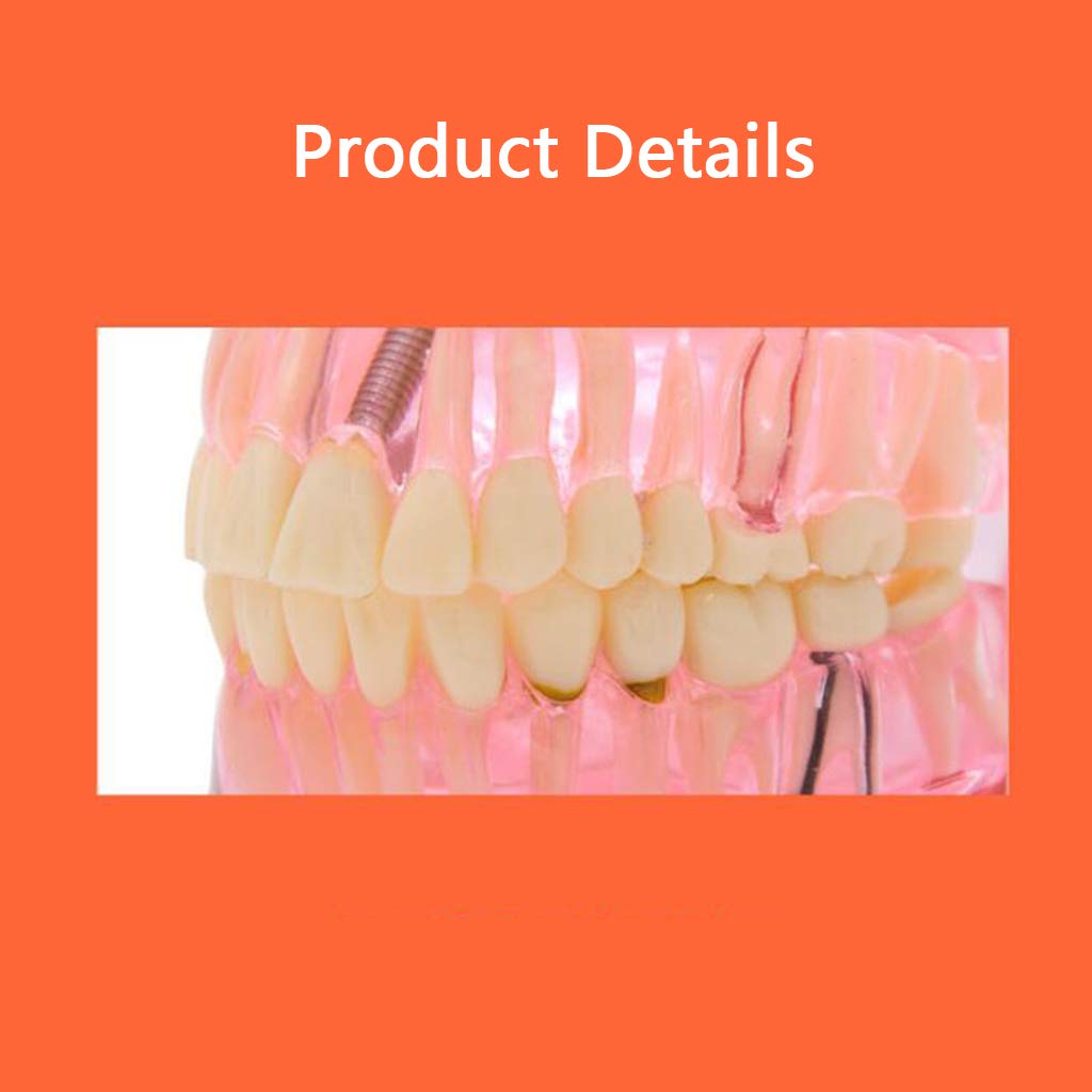 Modello Anatomico dei Denti - Modello di Dente per Addestramento alle Operazioni Ortodontiche Staccabili Trasparenti - per Aiuti allo Studio Educativo Medico, Attrezzature da Laboratorio