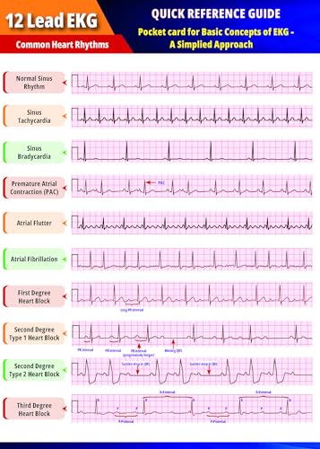 12 lead EKG Quick Reference Guide