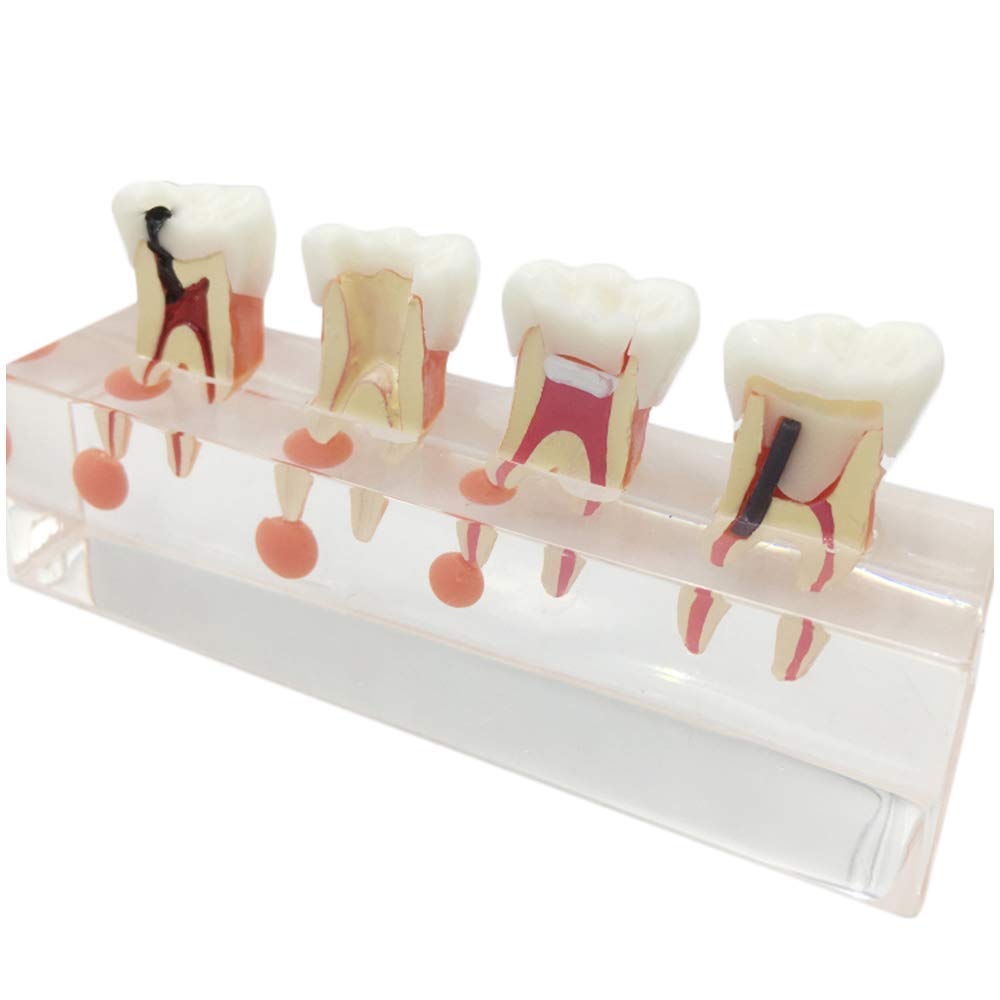 Buy Educational Model Dental Oral Cavity Pulp Disease Model Teeth