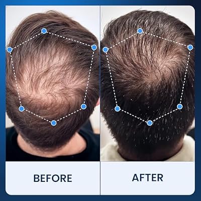 Hair Regrowth Serum for Thinning Hair, 30ml Clinically Backed Peptides, Biotin, Ginseng & Scutellaria Supports Hair Growth, Strengthens Roots, and Promotes Healthier Scalp