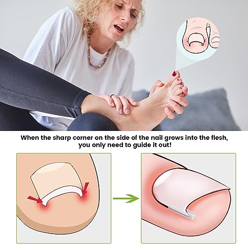 BEZOX Set zur Korrektur eingewachsener Zehennägel - 40 Stück schmerzfreie Zehennagelglättungsstreifen mit Zehennagelheber - einfaches Werkzeugset für eingewachsene Zehennägel