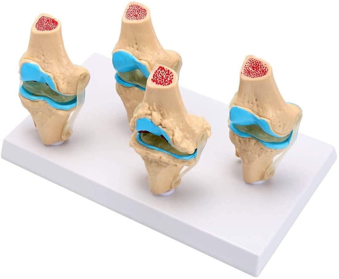 Modele medyczne, ludzki szkielet stawu kolanowego Model anatomiczny nauka medyczna materiały dydaktyczne osteoporoza modele stanu chorobowego 1 zestaw odłączany