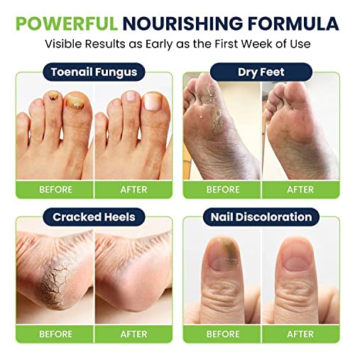 image for FOOT CURE Toenail Fungus Treatment Extra Strength - for fingernails, n