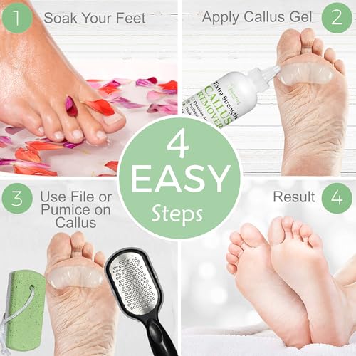 Image of Dr. Entre's Callus Remover Gel Kit for Feet: Foot File, Pumice Stone, 5 Glove Pairs for Gel Application, Spa Kit, Foot Care, Pedicure Tools, Scrubber, 8oz