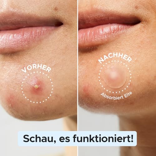 LitBear 480 Stück Pickel Patch für Gesicht, Hydrokolloid Pimple Patches zur Abdeckung von Pickel, Hautunreinheiten und Akne… – Ansicht 4