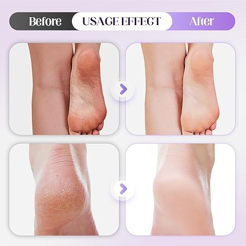 Miniatura 6 de Paquete de 10 piedras pómez con rayas, herramientas de pedicura para pies, depuradores de pies para ducha y bañera de pies, removedor de callos y