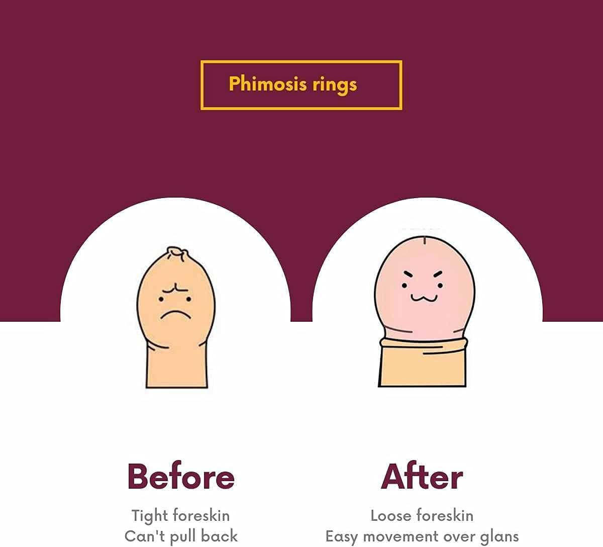 Vajraang Phimosis Stretching Rings (20 Rings Set) with Applicator Tool and 'How to use' Booklet