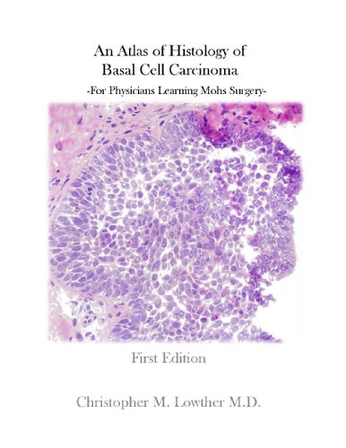 An Atlas of Histology of Basal Cell Carcinoma (For Physicians Learning Mohs Surgery)