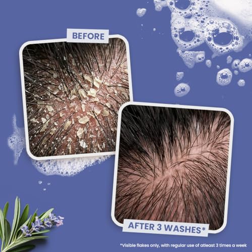 Image of Sesa Anti Dandruff Shampoo - 300ml | ZPTO Free Formula | Piroctone Olamine, Tea Tree & Rosemary Oil | Upto 100% dandruff reduction | Prevents Itching & Irritation | Safe for Daily Use | Unisex